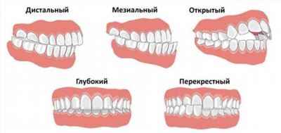 Как повысить КБМ после ДТП