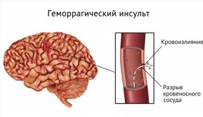 Реабилитация после инсульта в раннем восстановительном периоде